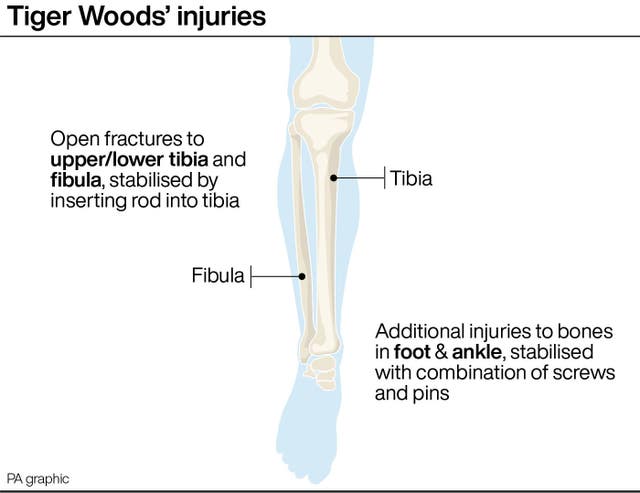 The injuries Woods suffered in his car crash (PA Graphics)