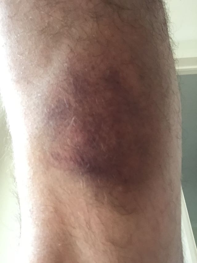 Bruising on the legs of Craig Skillicorn