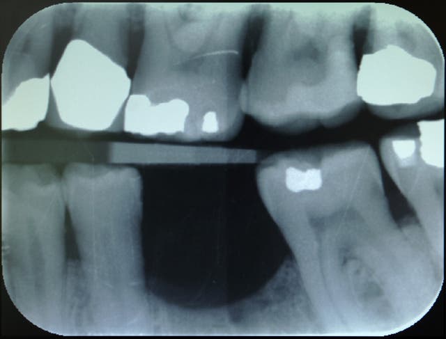 Dental X-Ray