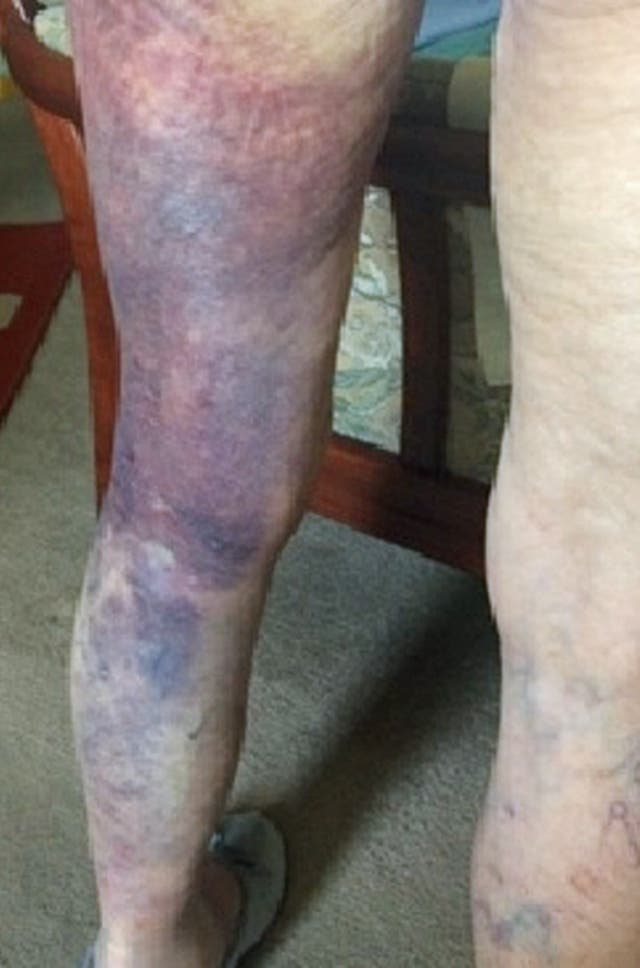 Injuries sustained by the 92-year-old woman (Met Police/PA)