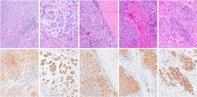 A composite image of melanoma Garp