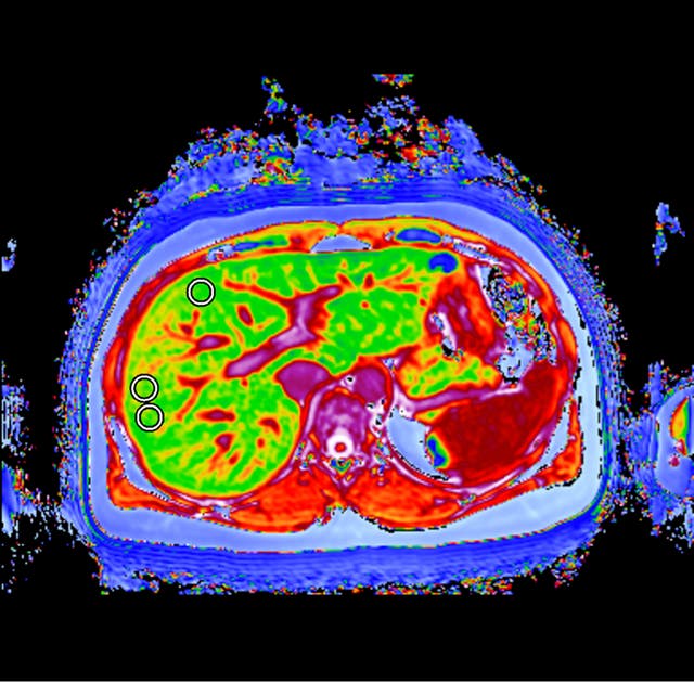 A liver with fibrosis and inflammation caused by NASH (Mearns & Pike/PA)