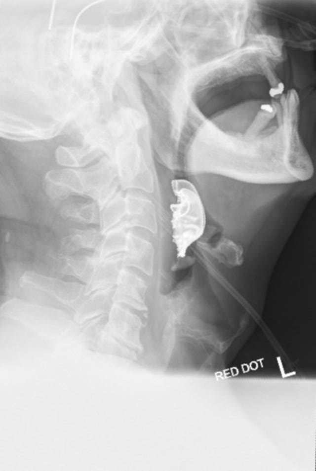Dentures in throat
