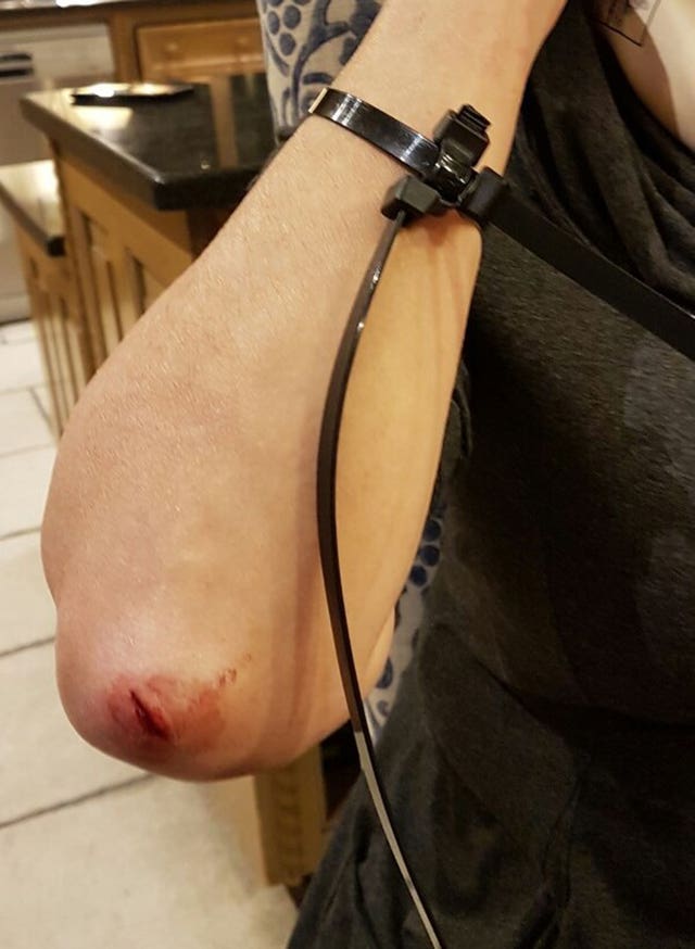 Susan Morris's injuries after the raid (Surrey Police/PA)