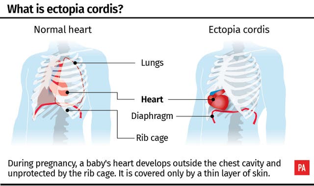 HEALTH Heart