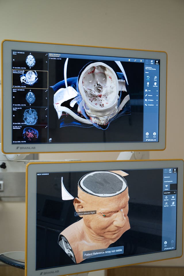 Grandfather receives pioneering UK-first operation to treat brain issue ...