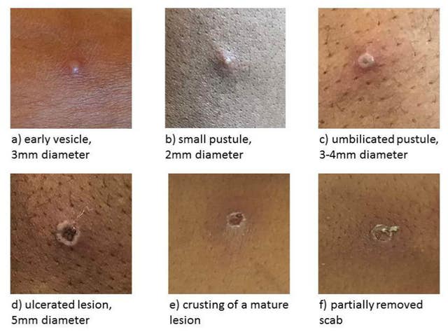 The stages of Monkeypox (UK Health Security Agency/PA)