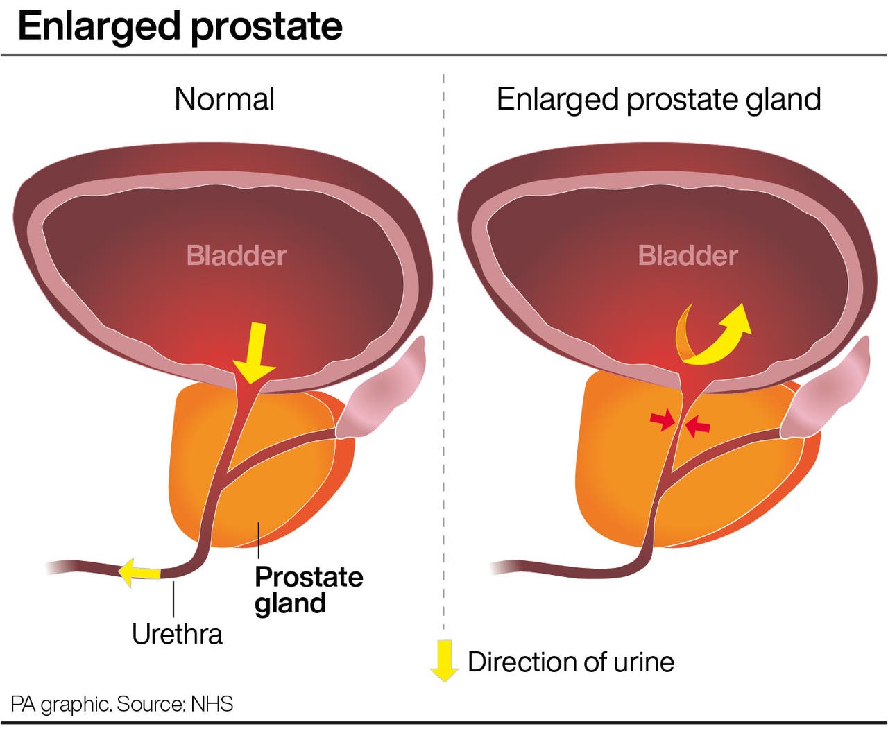 jump-in-searches-for-enlarged-prostate-following-king-s-revelation