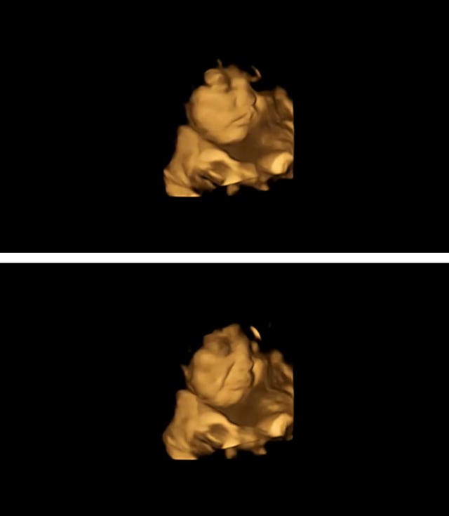 4D ultrasounds images show fetuses’ reactions to taste