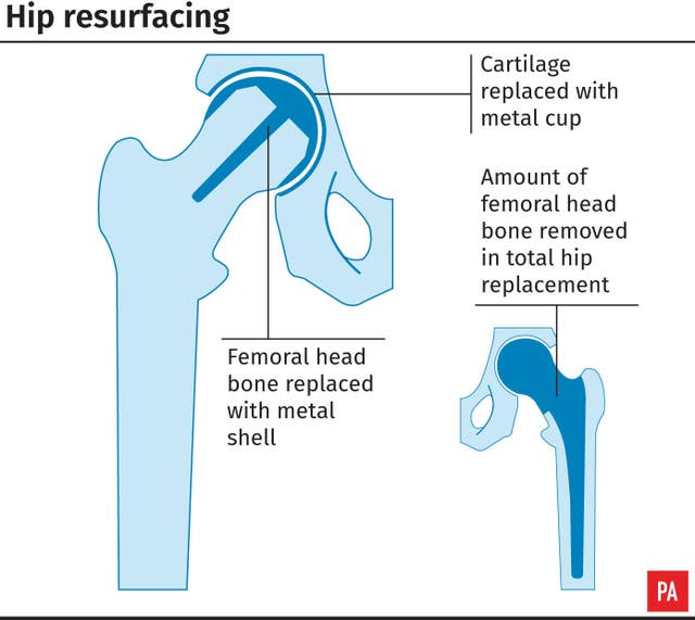 Andy Murray undergoes hip resurfacing surgery - Sports Mole