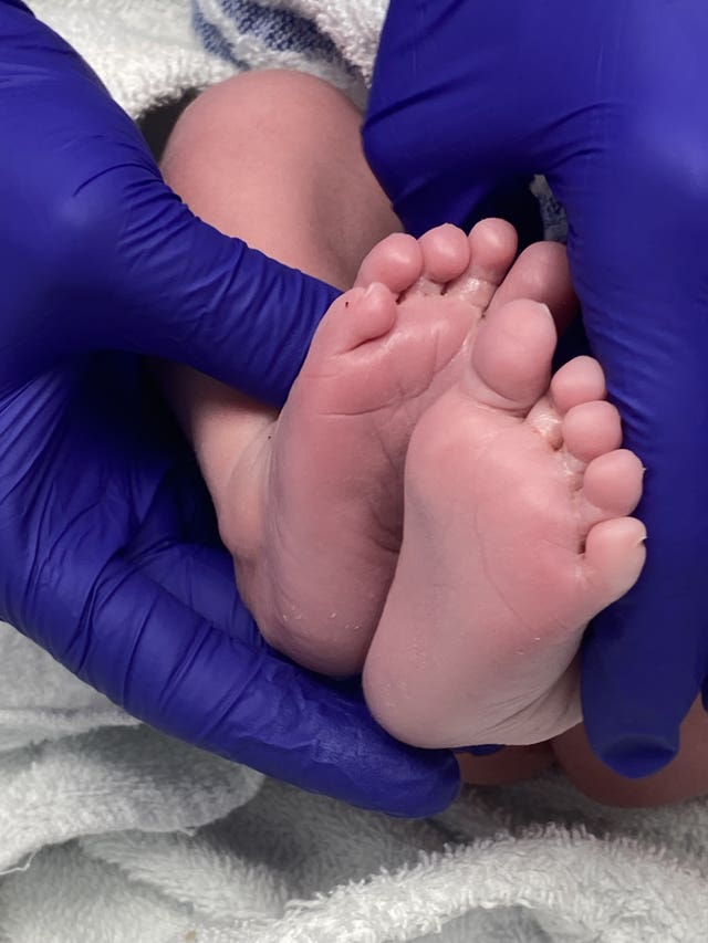 Hugo's feet in the operating theatre 