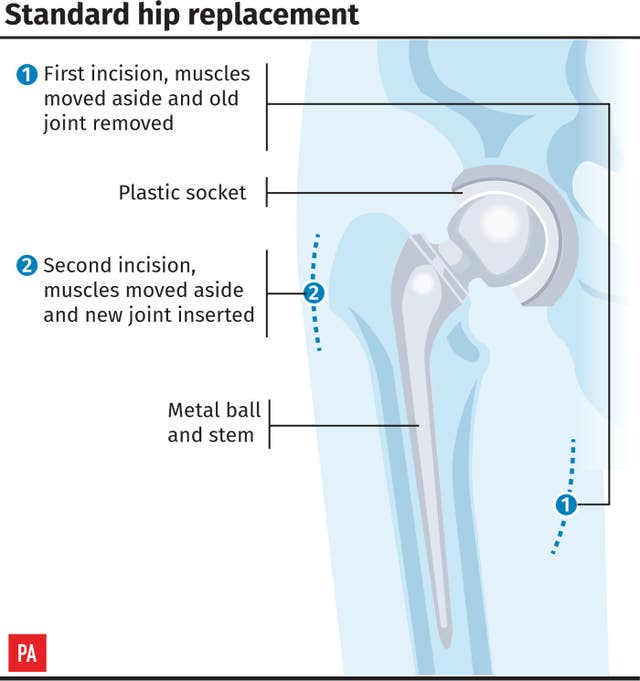 Hip replacement graphic