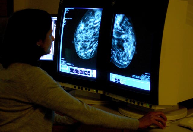 A consultant studies a mammogram on a computer screen.