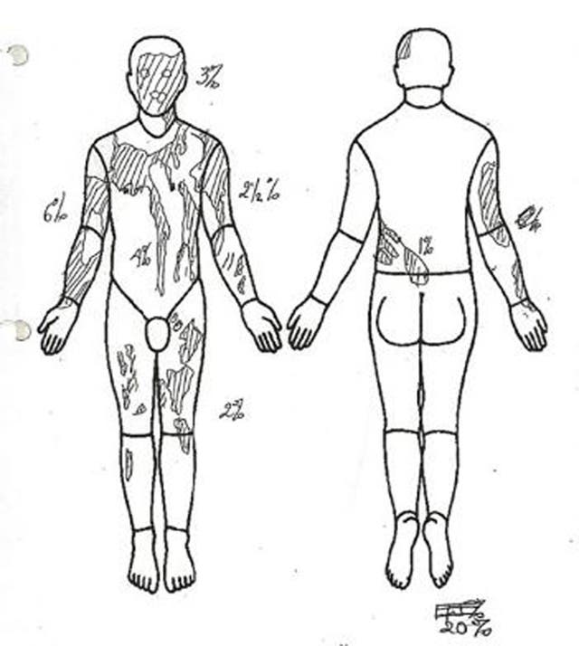 A body map showing the injuries on Mark van Dongen from the acid attack (Avon and Somerset Police/PA)