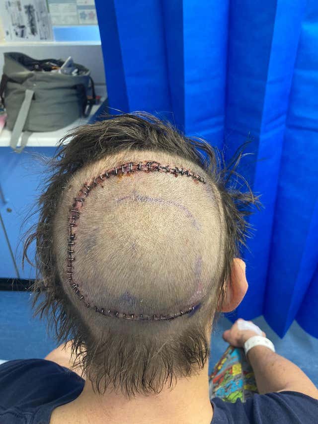 Craig Russell and his post surgery scar