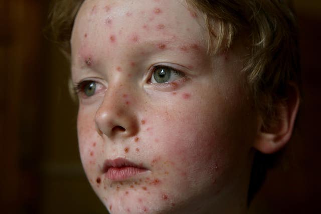 Chicken pox