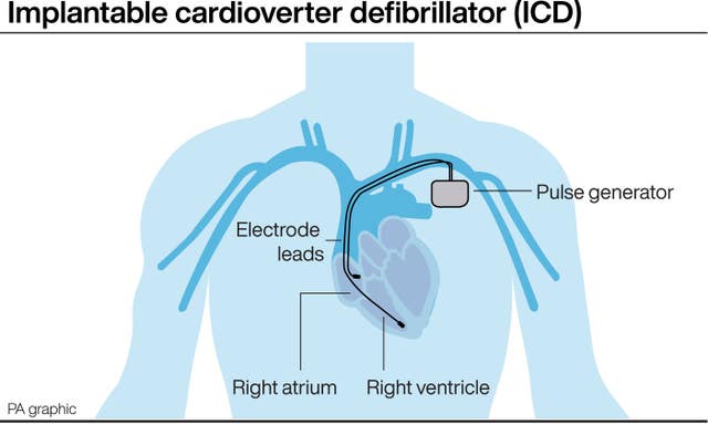 Eriksen was fitted with an Implantable cardioverter defibrillator following his cardiac arrest at Euro 2020.