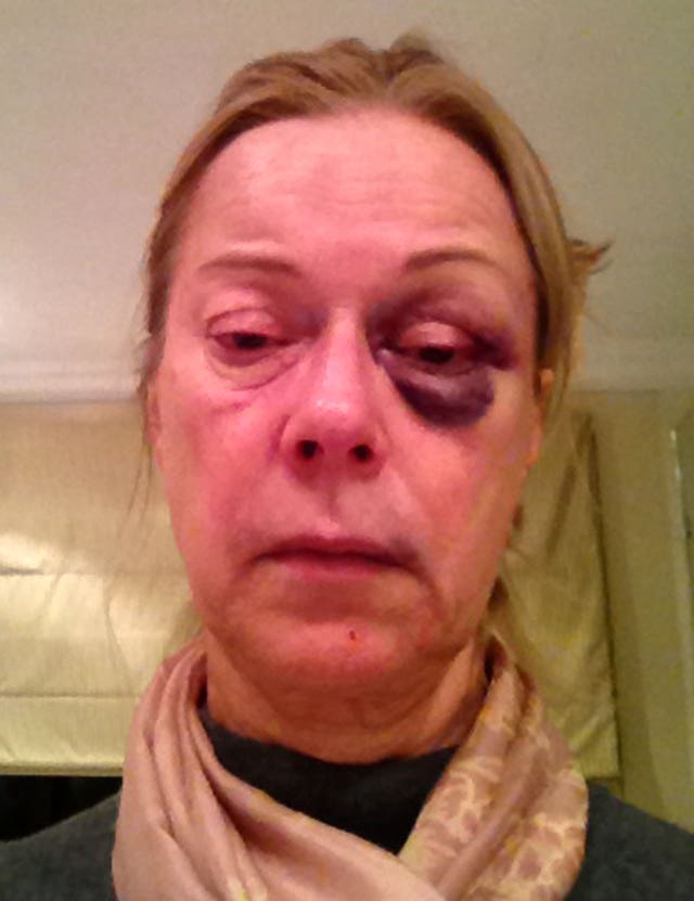 The injuries sustained by Susan Morris during a raid on her home (Surrey Police/PA)