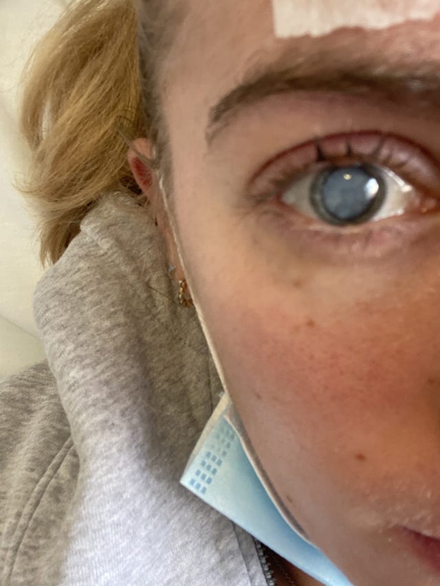 Ellie’s rare bacterial eye infection on the day of her cataract surgery