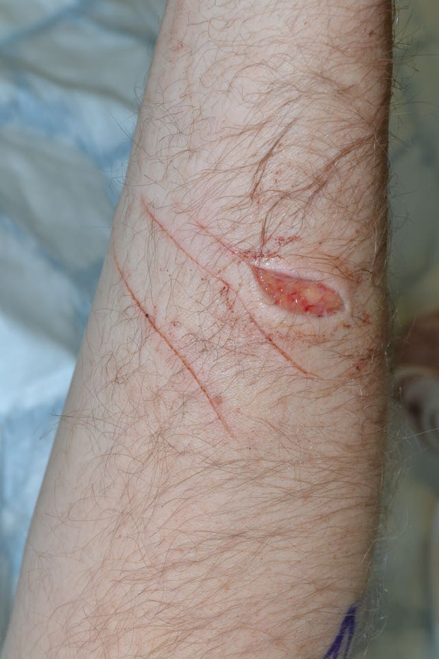 A wound on Pc Outten's arm