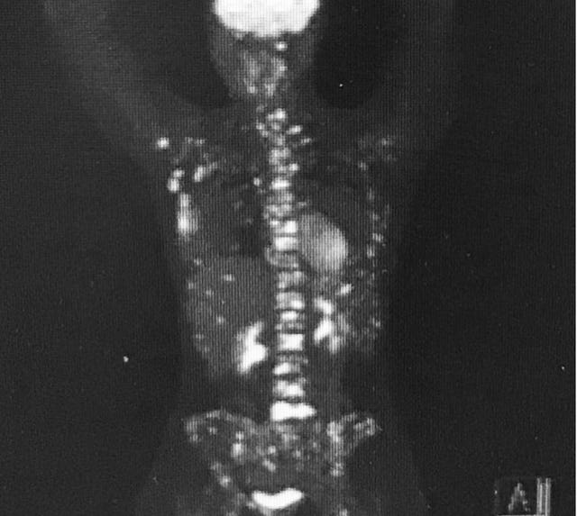 An x-ray image showing Nicky Newman’s body 