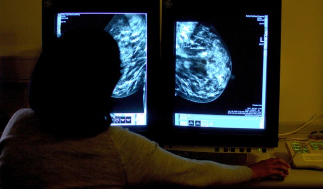 Breast cancer screening