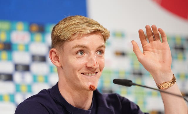 England’s Anthony Gordon during a press conference at Euro 2024 with grazes visible on his chin and nose