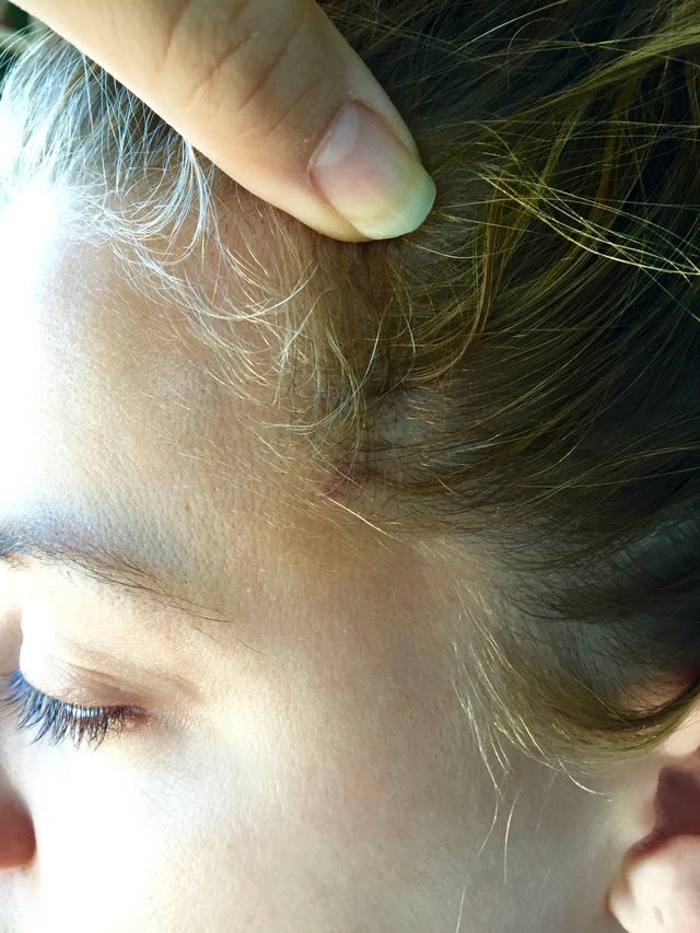 Picture shown in court of injuries said to have been sustained by Amber Heard during an incident in which Johnny Depp has admitted to 'accidentally' headbutting her 